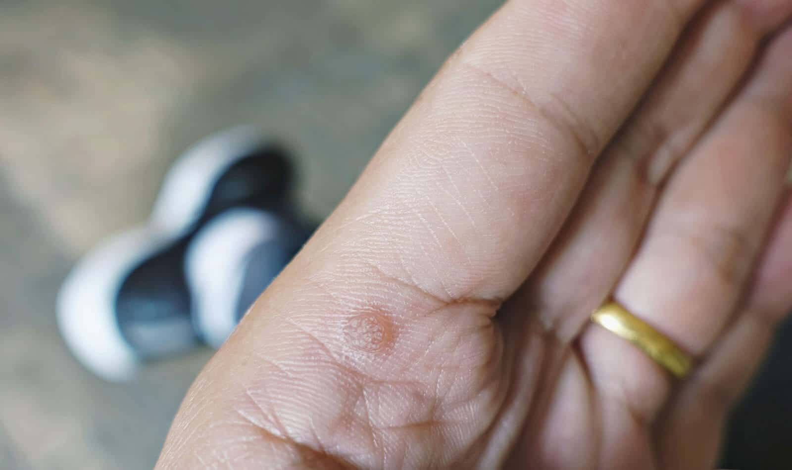 Warts